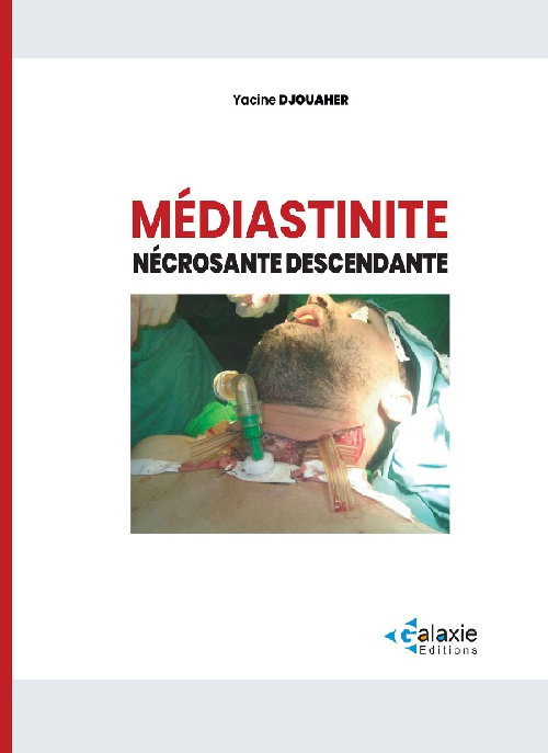Médiastinite Nécrosante Descendante