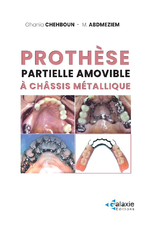 Prothèse Partielle Amovible à Châssis Métallique